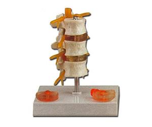 GiMa 40180 modèle maladie hernie, Lot de 1 pièce