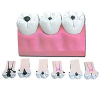 GiMa 40211 modèle carie, Lot de 1 pièce