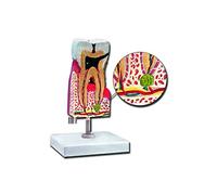 GiMa 40214 modèle molaires inférieures avec CARIES, Lot de 1 pièce
