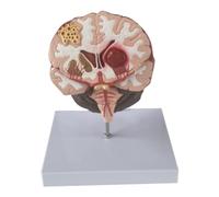 Giwnhvx Modèle de maladies cérébrales humaines - Pathologie cérébrale, hémorragie du tronc cérébral, modèle d'enseignement médical - Modèle anatomique du cerveau humain