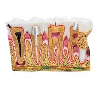 Glixoft Modèle D'anatomie Dentaire, Comparaison des Caries, Modèle D'étude, Modèle De Développement, Fourniture D'éducation Dentaire pour Les Études Dentaires
