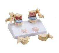 GPDNBIEU, Modèle de lésion d'ostéoporose squelettique humaine, modèle, for la démonstration pédagogique