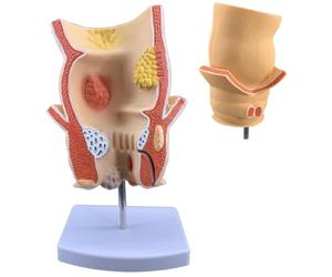 GPDNBIEU, Simulation de maladie hémorroïdaire, modèle pathologie rectale humaine, d'acné ano-rectale avec base