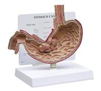GPI Anatomicals 2001 Modèle de cancer de l’estomac