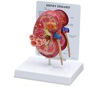 GPI Anatomicals 3260 Modèle de rein malade