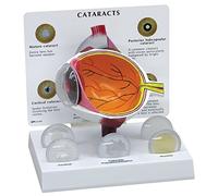 GPI Anatomicals W47852 Œil avec cataracte