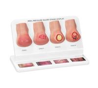 Heel Pressure Injury Stages Model, Heel Ulcer Demonstration Model, Bed Sore Stages Education Tool for Training