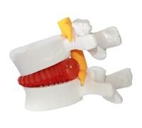 Herniée Disc Relief Teaching Aids, PVC Human Corps Model of Herniated Lumbar Vertebrae Disc, 1,5 fois Modèle de colonne lombaire grandeur nature pour l'enseignement, l'apprentissage et la démonstrati