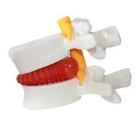 Herniée Disc Relief Teaching Aids, PVC Human Corps Model of Herniated Lumbar Vertebrae Disc, 1, 5 fois Modèle de colonne vertébrale de grandeur nature pour l'enseignement, l'apprentissage et la démons