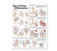 Hip And Knee Inflammations Anatomical Chart