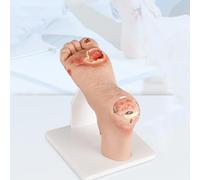 HKFGSHOP Modèle De Pied Diabétique, Lésions Purulentes De La Plaie (maladie Légère De Niveau 1 À 3 Ou Grave De Niveau 4 À 5), Simulateur De Pied Diabétique avec Plaque Graduée, Outil De Démonstration
