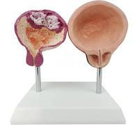 HKFGSHOP Modèle De Vessie Saine Et Pathologique, Modèle Anatomique De La Vessie Abdominale Masculine, Modèle Comparatif De Démonstration De La Vessie chez Les Fumeurs, Outil Pédagogique en Urologie