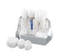 Hoite Modèle d'implant dentaire transparent avec couronnes en résine, implants métalliques, piliers, pièces séparables, 4 aimants, pont sécurisé