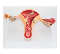 HUIBBGO Modèle corporel, modèle de Squelette, modèle d'étude, modèle de pathologie de l'utérus féminin, Corps de Femme, modèle d'utérus et d'ovaires pathologiques, Anatomie