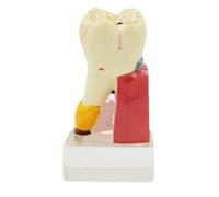 HUIBBGO Modèle de cavité pathologique Quadruple et Complet Modèle pathologique Complet des lésions dentaires Modèle d'organe Humain Carie Dentaire Modèle Dentaire Guérison Dentaire Modèle