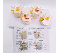 Humain 4 étapes du modèle de maladie de la colonne vertébrale lombaire, modèle anatomique 4 étapes modèle anatomique lésion lombaire humaine statue colonne vertébrale ostéoporose vertèbre modèle