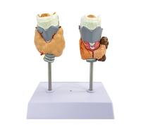 Humaine Thyroïdienne Pathologie Modèle, Modèle de Kyste Tumoral de la Gorge Thyroïdienne, Modèle Anatomique Réaliste de la Pathologie Thyroïdienne Humaine, 16,5 x 13 x 20 cm