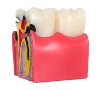 Ipetboom Modèle Caries Comparative pour Étudiants Démonstration Bucco- Enseignement Oral