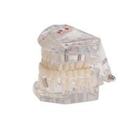 iplusmile Modèle Pédagogique Amovible Résine Écologique Modèle Oral pour Enseignement et Planification de Démonstration Provisoire de Dents et Bridge