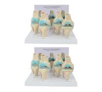 Jnchdghwa 2X Kit de Genou Modèle D'Anatomie de L'Arthrose avec Carte ucative Modèle de Genou en 4 Étapes Aides Pédagogiques Orthopédiques