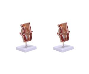 Jnchdghwa 2X Modèle D'Anatomie Modèle de LéSion HéMorroïDe Rectale Humaine Fistule HéMorroïDe Fistule Fissure Pathologie Modèle D'Enseignement