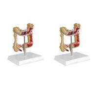 Jnchdghwa 2X Modèle de Colorectal Pathologique Du Côlon Modèle de Gros Intestin Modèle Anatomique -Intestinal