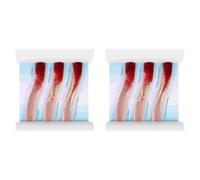 Jnchdghwa 2X Modèle Dynamique de Vaisseau Sanguin Modèle de Contraste de Blocage Cardiovasculaire Modèle de Thrombose pour L'Explication de L'Enseignement