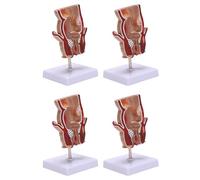 Jnchdghwa 4X Modèle D'Anatomie Modèle de Lésion Hémorroïde Rectale Humaine Fistule Hémorroïde Fistule Fissure Pathologie Modèle D'Enseignement