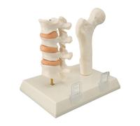 Karlak Modèle Pathologique D'ostéoporose, Enseignement de L'anatomie | Conception ABS durable, parfaite pour les conférences, les modèles pour les laboratoires d\'anatomie, l\'outil de formation