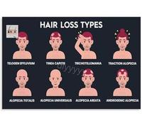 KCDFDVJFBM Salon Decor Educational Canvas Wall-Art Hair Loss Types and Patterns Chart Hair Health Science for Bedroom Decor(Unframed,16x24inch(40x60cm))