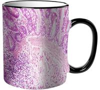 KDWJS Mug porcelaine fine Mug Tasses de 11 oz 330ml pour collègue,amis,frères et soeurs imprimer Tasse de café exquis CadeauVue microscopique d'un adénocarcinome à cellules canalaires provenant d'une