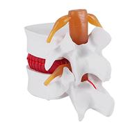 Kissmii Modèle de DéMonstration de Hernie Discale Lombaire Humaine 1: 1.5 Du Modèle de Colonne VertéBrale Lombaire pour L'Anatomie Humaine