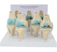 Kit de genou modèle anatomique d'arthrose, modèle de pathologie anatomique de maladie de l'articulation du genou en 4 étapes avec base, outil d'enseignement médical for l'apprentissage