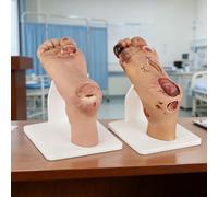 Kit de pathologie de l'ulcère du pied diabétique pour démonstrations de soins des plaies, simulateur de pied diabétique léger à sévère en deux étapes