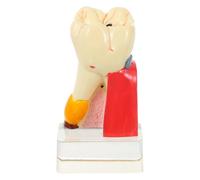 KJHBV Modèle de Démonstration Dentaire Léger et Solide, Modèle de Carie pour Utilisation en Formation Professionnelle et Enseignement Buccal