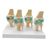 KXJSYL Tool 1pc Modèle d'anatomie de l'articulation du Genou pathologique Humaine en Quatre étapes Ressources pédagogiques en Sciences médicales Dropshipping