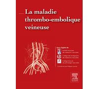 La maladie thrombo-embolique veineuse