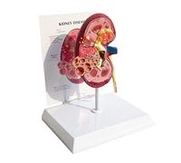 LBYLYH Rein W/Pathologies Model Human Body Anatomy Replica of Diseased Kidney for Office Educational Tool