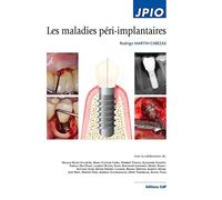 Les maladies péri-implantaires
