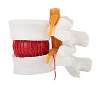 LiebeWH Modèle de Démonstration Médicale de Hernie Discale Lombaire Humaine en Plastique, Modèle 1: 1.5 de Modèle de Disque Lombaire Humain de Colonne Vertébrale Lombaire pour l'Enseignement Linéaire