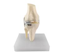 LKYLVEE Modèle d'articulation du Genou à Condyle Unique - Modèle de Remplacement Total du Genou - Outil d'enseignement Anatomique pour l'éducation et l'étude des Patients,A,15cm