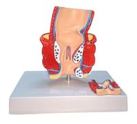 LKYLVEE Modèle de pathologie de l'acné anorrectale - Modèle pédagogique médical des hémorroïdes - Modèle Anatomique intestinal Rectal,B,14CM