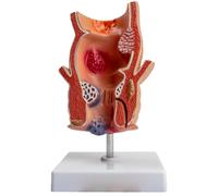 LKYLVEE Modèle de pathologie rectale Humaine - Modèle Anatomique de lésion rectale - Organes viscéraux pour l'enseignement de la Chirurgie du côlon et du Rectum,Flesh,20CM