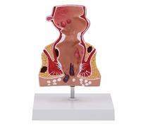LKYLVEE Modèle Humain de hémorroïdes rectales - Modèle de pathologie colique - Outil pédagogique pour la Chirurgie anorectale,Rouge,22CM