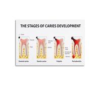 LLBOGRGGN Understanding Tooth Decay Poster - Visual Guide to Caries Development Stages, Educational Wall Decor for Clinic(Unframed,12x18inch(30x45cm))