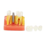 LOLIPPYY Modèle Agrandi pour Enseignement Oral Communication Patients et Démonstration Éducative