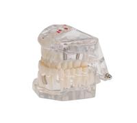 LOLIPPYY Modèle Pédagogique Amovible pour Implant et Bridge Modèle de Dents Résine Écologique pour Étudiants et Consultation Patients