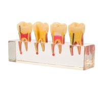 LOPUNER Modèle Dentaire Éducatif en Résine pour Étudiants et Jeunes Patients, Visualisation Progression des Caries et Pratique Manuelle en Structure Buccale pour L'éducation