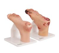 Lot de 2 modèles éducatifs pour ulcère du pied diabétique - Précision anatomique pour étude de pathologie légère et sévère - Outil d'entraînement médical pour les professionnels de la santé