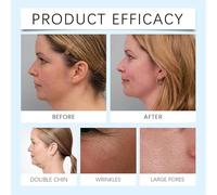 Lot de 5 masques de menton de chinologie - Masque de levage de menton pour double menton - Dites adieu à votre double menton maintenant